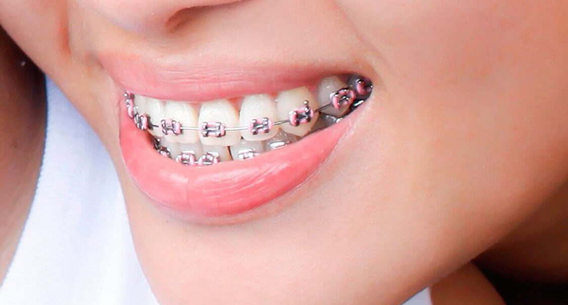 Ortodoncia con Brackets en Saltillo: Tu Sonrisa Perfecta al Alcance en Belle-Dent